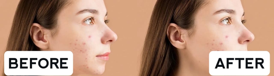 Jasa photoshop edit foto wajah, edit foto prewedding, hapus jerawat, hapus bekas jerawat, edit foto online, edit foto profesional, edit foto muka, jasa edit foto online, harga jasa edit foto