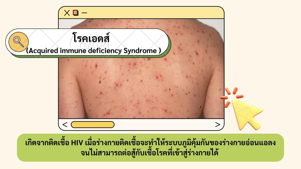 รับทำพรีเซนเทชั่นโรคเอดส์ ภาพสไลด์งานนำเสนอ