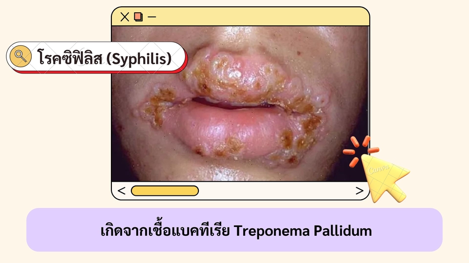 รับทำ presentation โรคซิฟิลิส Treponema Pallidum