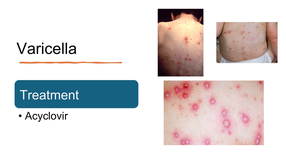 รับทำ presentation วาริเซลลา Acyclovir