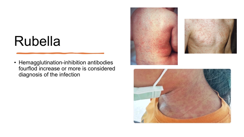 รับทำ presentation โรคหัดเยอรมัน