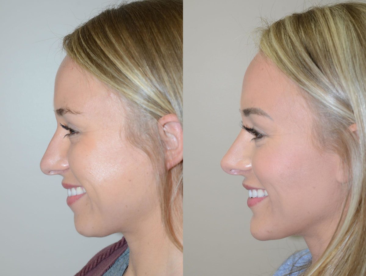 Rhinoplasty Surgery - Sound Plastic Surgery, Cosmetic Plastic Surgery  Clinic Seattle