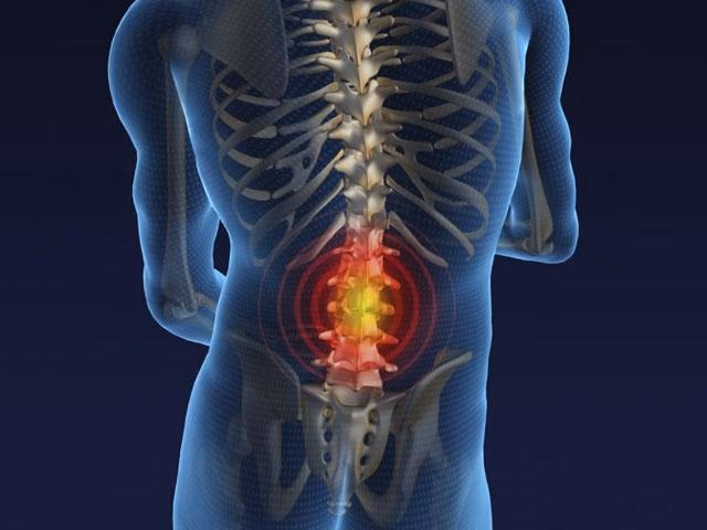 Imagen relacionada con Definición y causas de la hernia discal