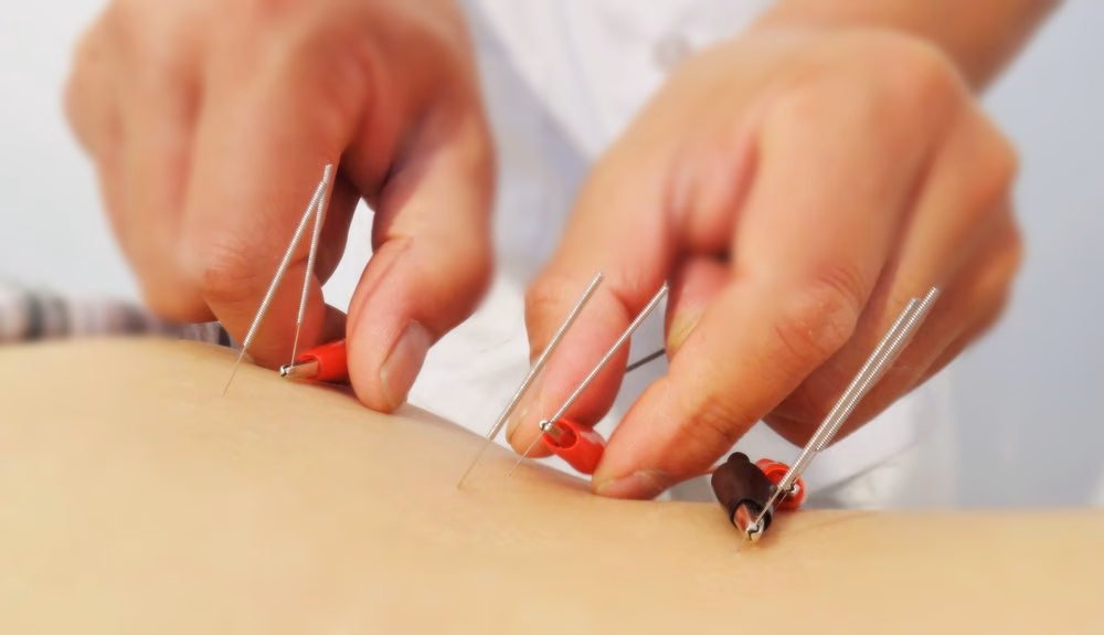 Qué es y cuáles son los beneficios de la electroacupuntura