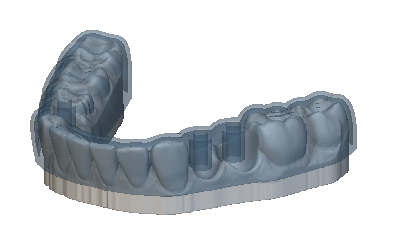 stent