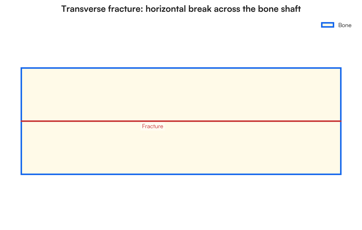 Name the types of fracture. Draw and discuss in detail. | Filo