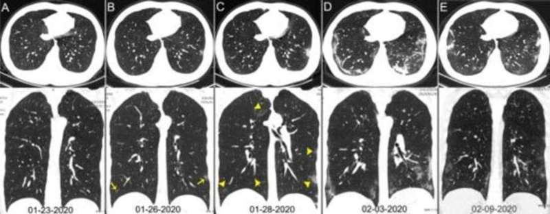 Gambar CT dada seorang pria berusia 29 tahun yang dites positif SARS-CoV-2 pada 5 Febuari_ 2020_ Panah warna kuning menunjukkan adanya GGO_ Foto_ Tao Ai et al_RSNA (dari Kumparan_com)