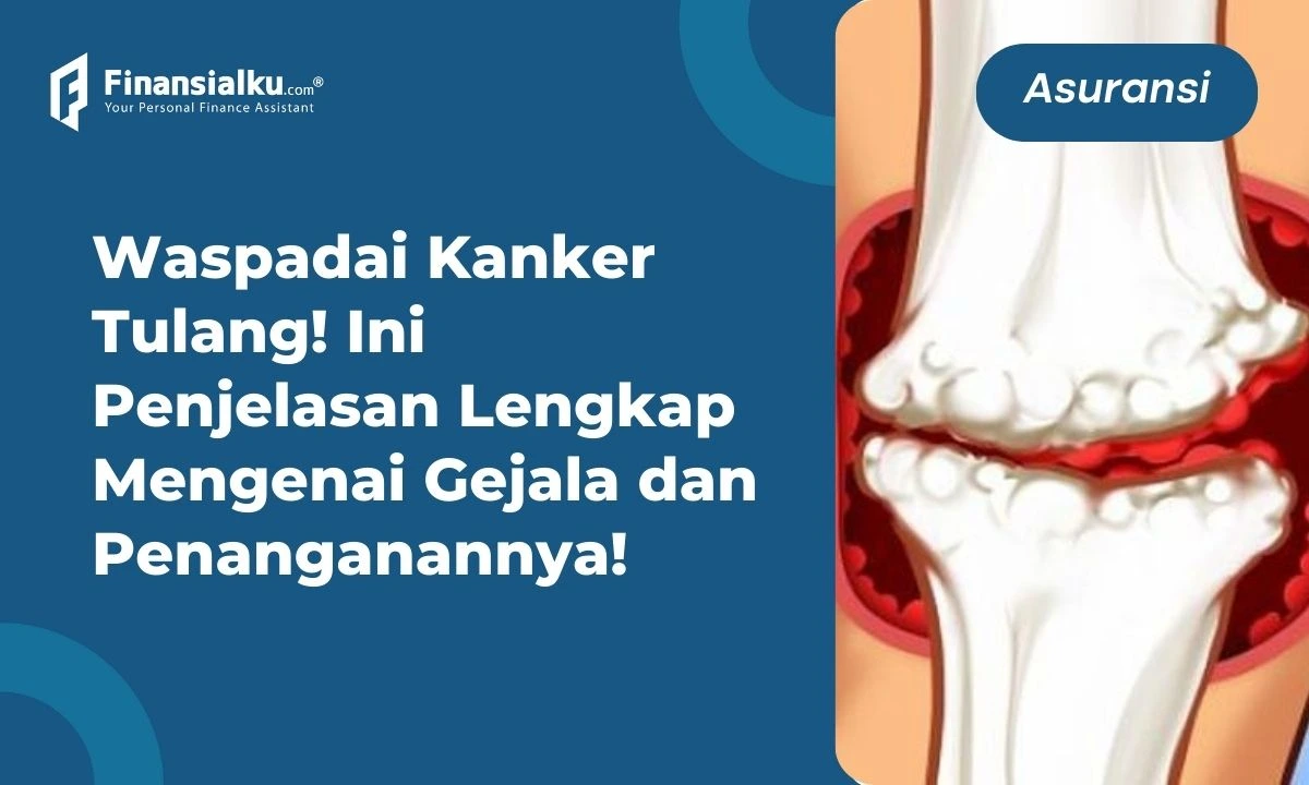 Penting: Kenali Gejala, Penanganan, dan Biaya Pengobatan Kanker Tulang