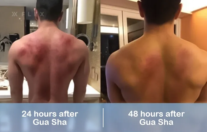 A patient showing the different stages of recovery after a gua sha session immediately after, 24 hours and 48 hours after