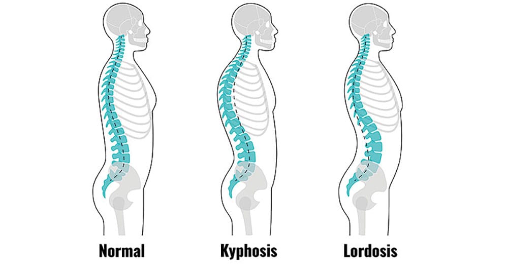 A human model with normal back, kyphosis, and lordosis