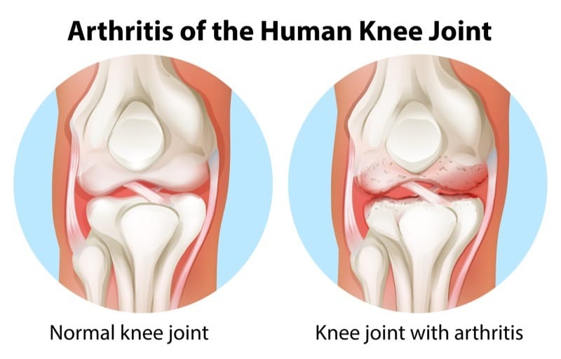 Knee osteoarthritis