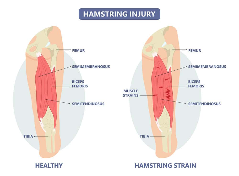 Torn hamstring