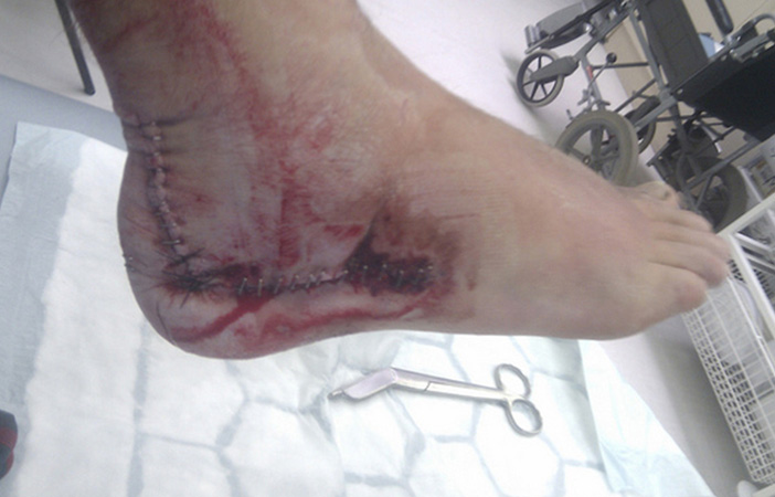 Snowboard Injury Ankle