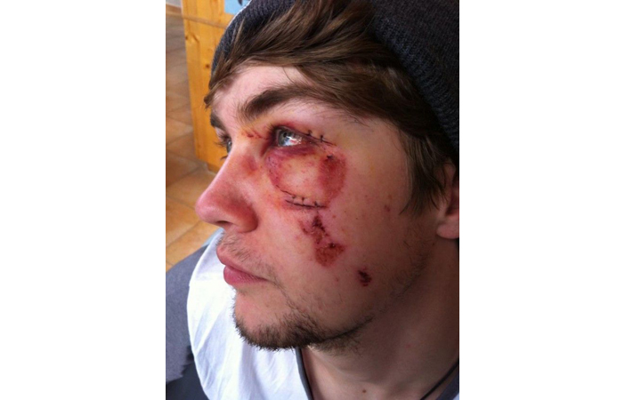 Snowboard Injury Face Stitches