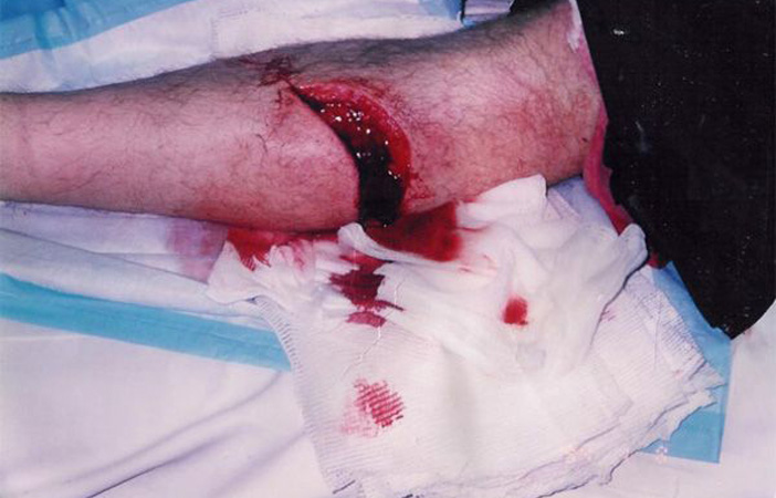 Snowboard Injury Gash Leg Calf