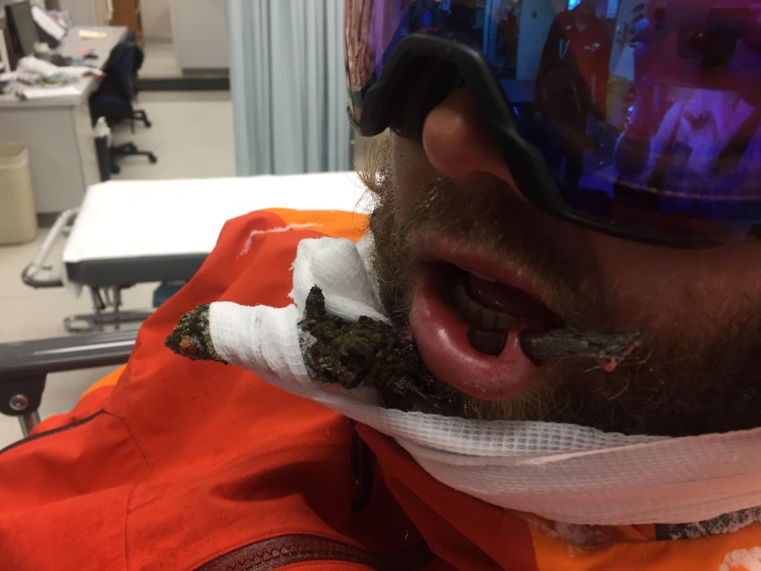 ski instructor stick in face