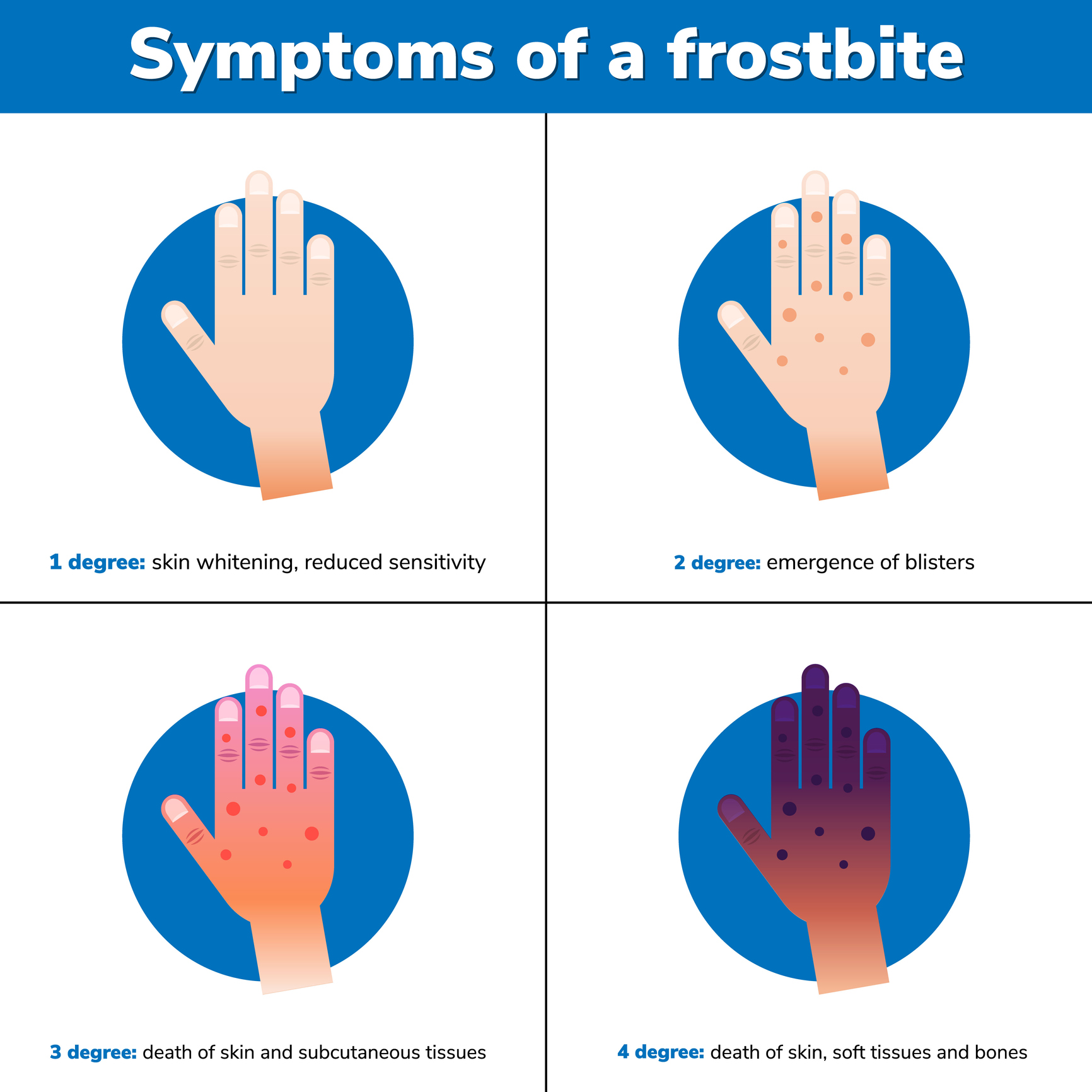 Frostbite and Frostnip | How To Prevent And Cure