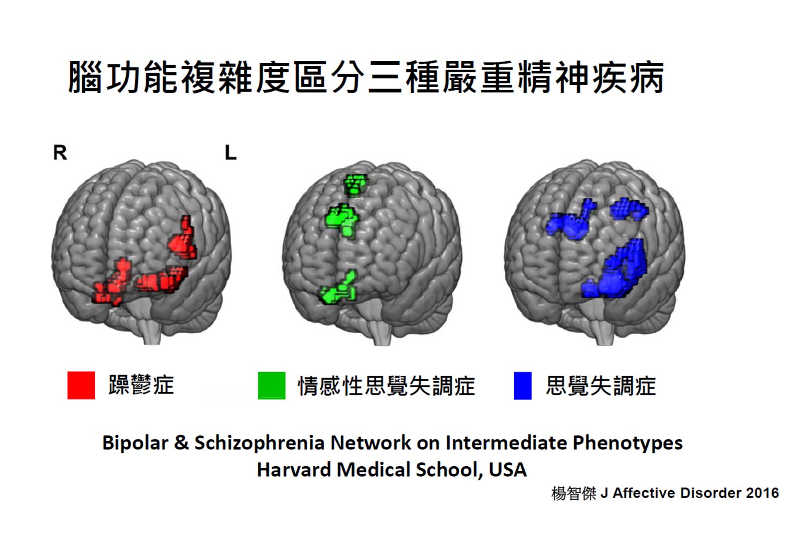 腦功能複雜度區分三種嚴重精神疾病。