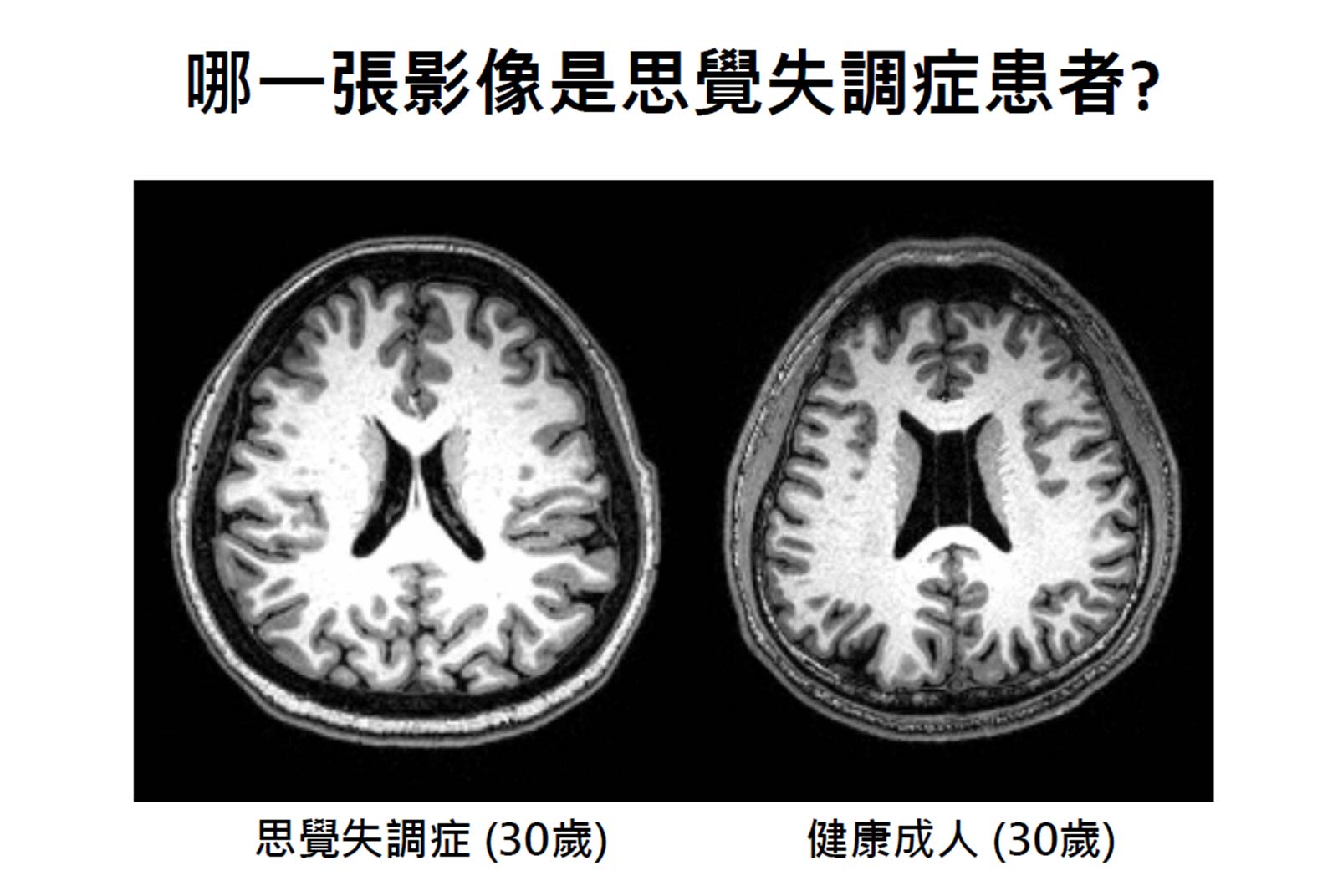 思覺失調症患者與健康成人腦影像圖比較。