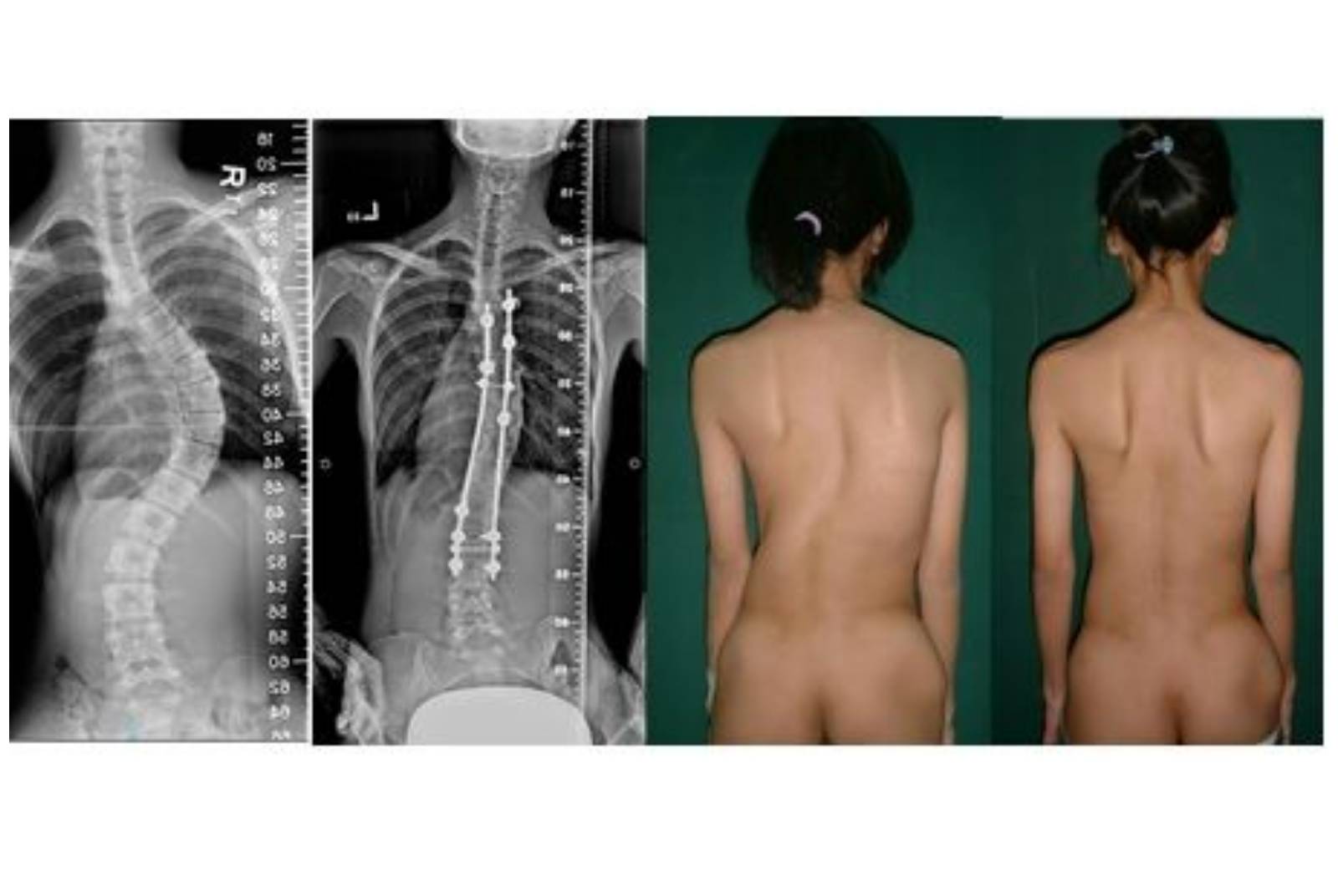 完整專業的跨領域醫療團隊，從手術、復健到心理支持，致力脊椎側彎的全方位照顧，手術品質及照護全球第一