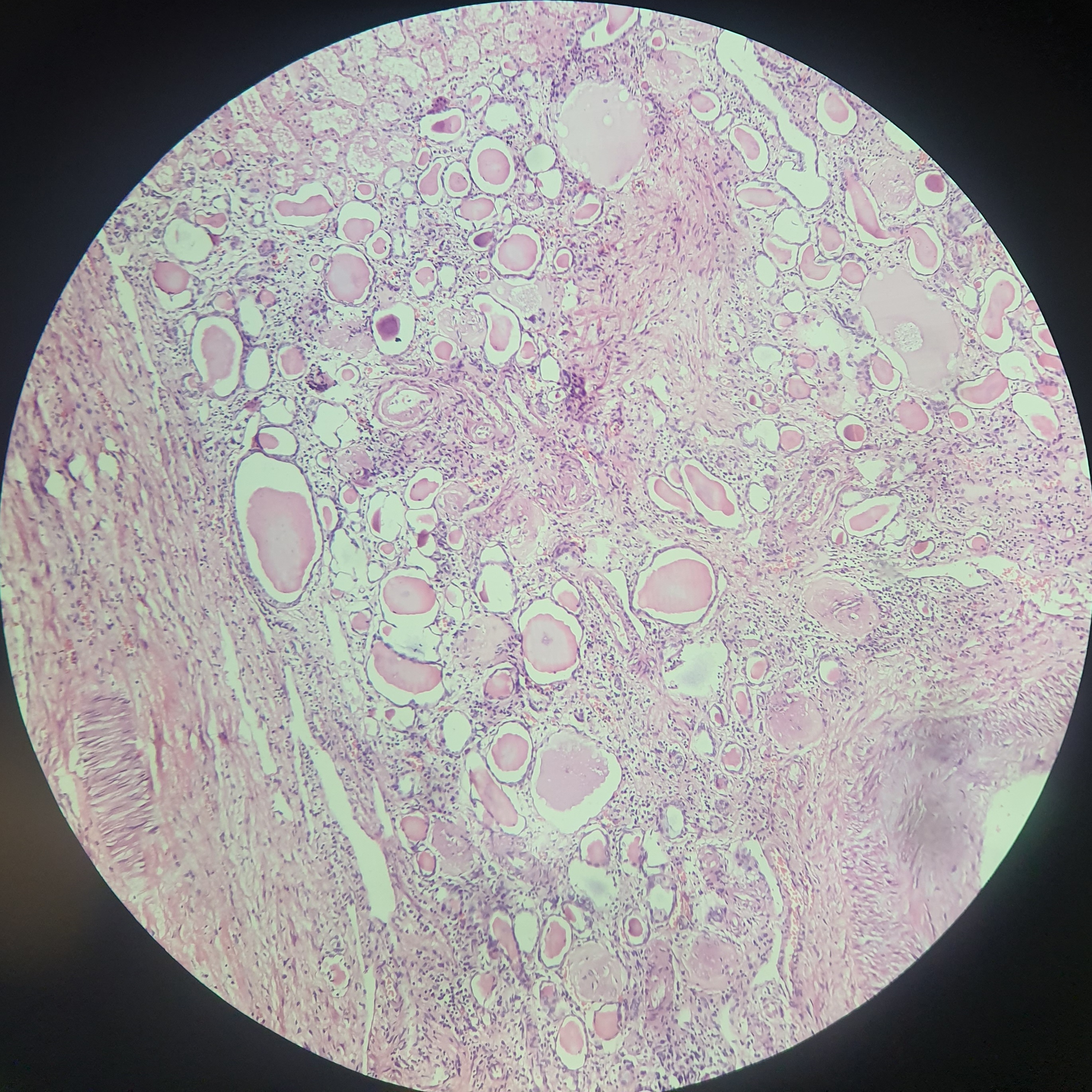 Chronic pyelonephritis2.jpg