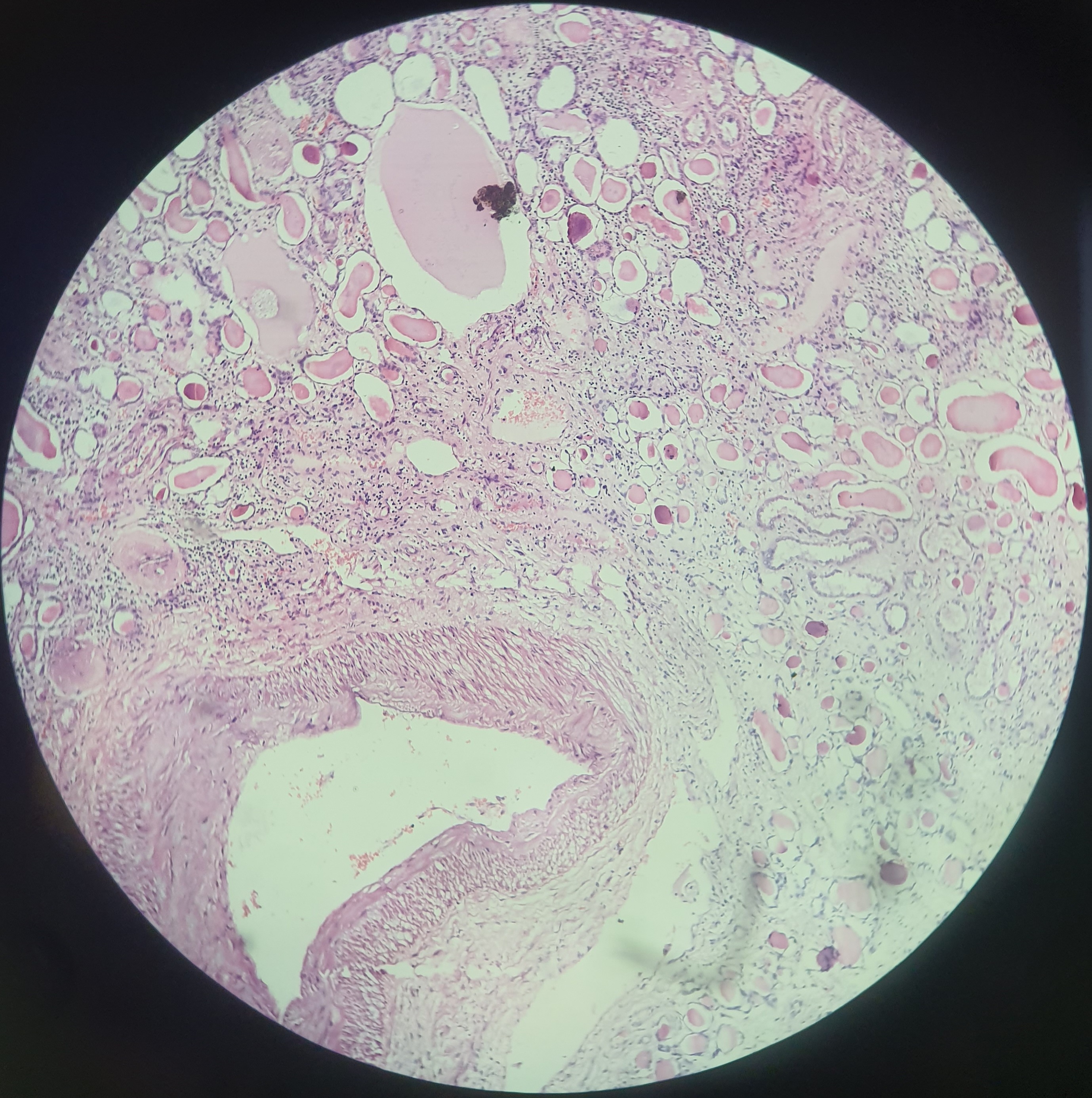 Chronic pyelonephritis3.jpg