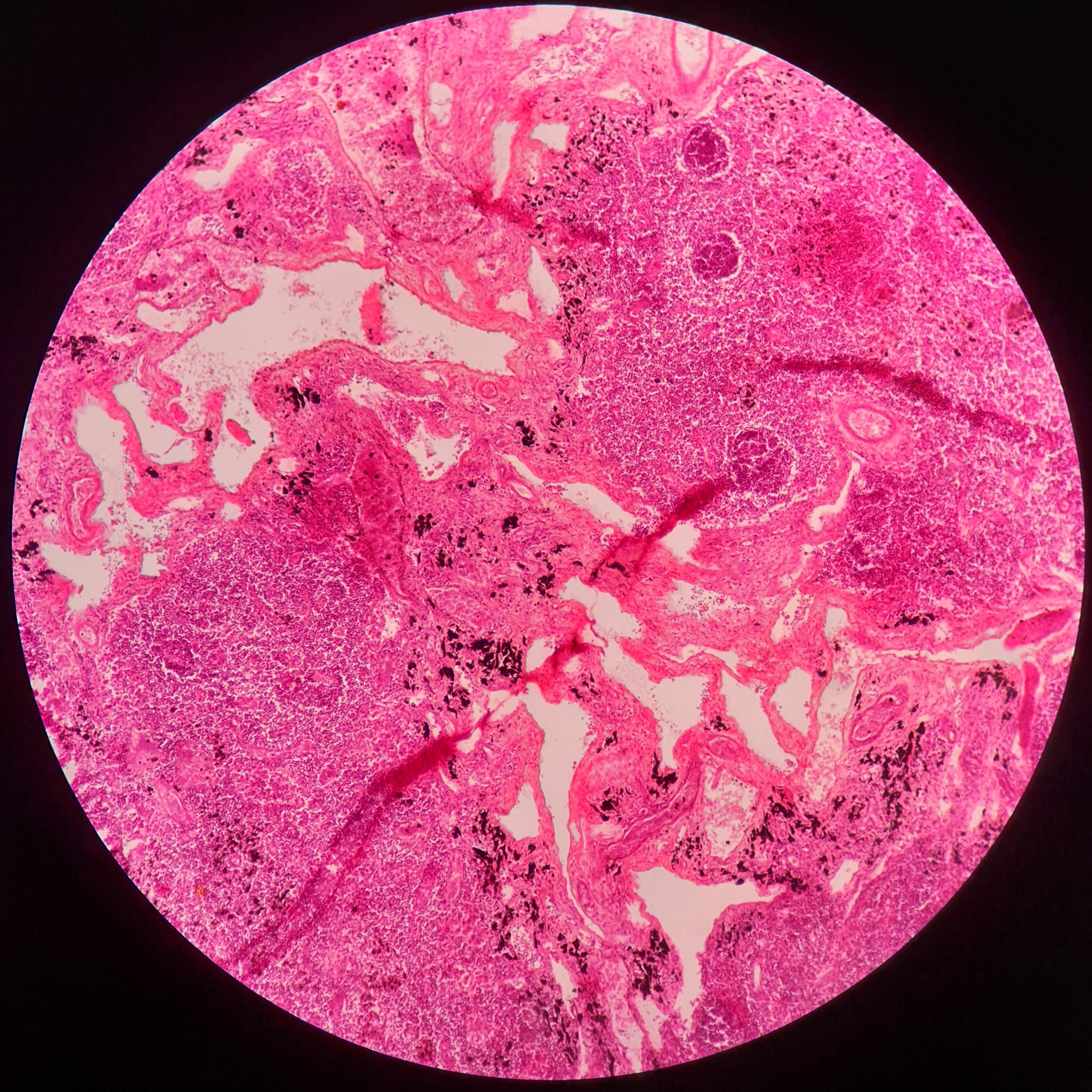Lymph_node1.jpg