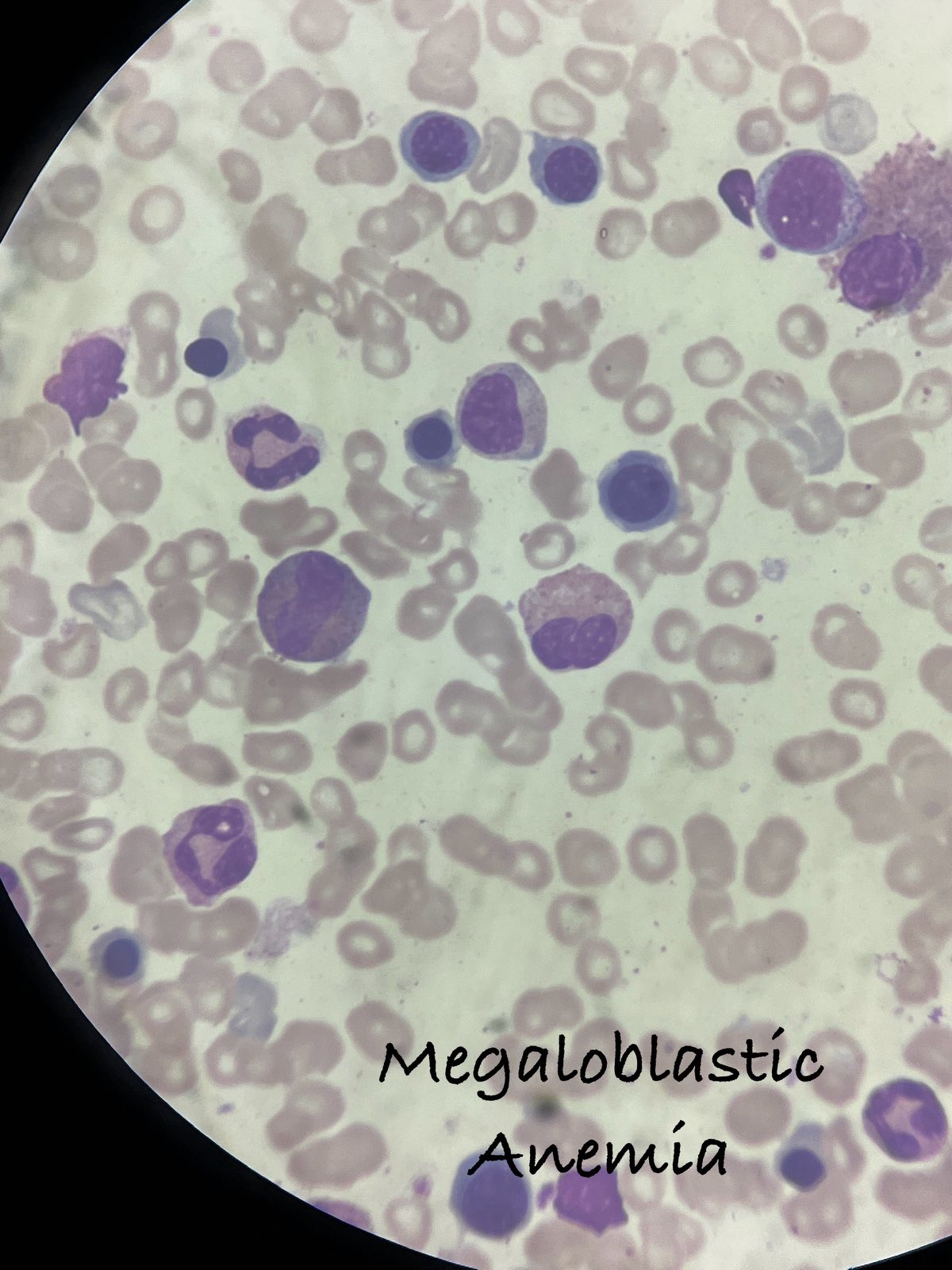 Megaloblastic_anaemia_1.jpg