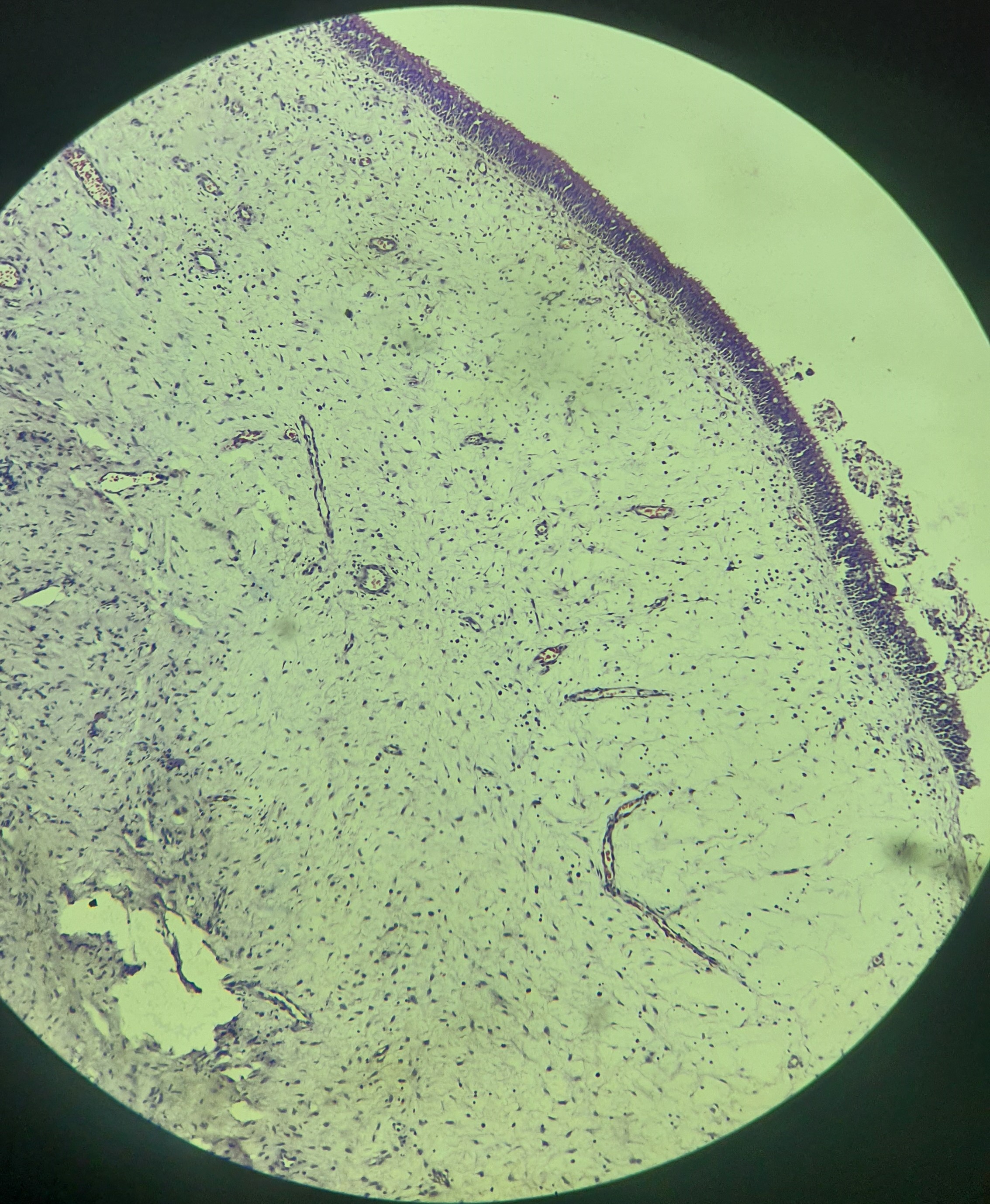 Nasal polyp.jpg