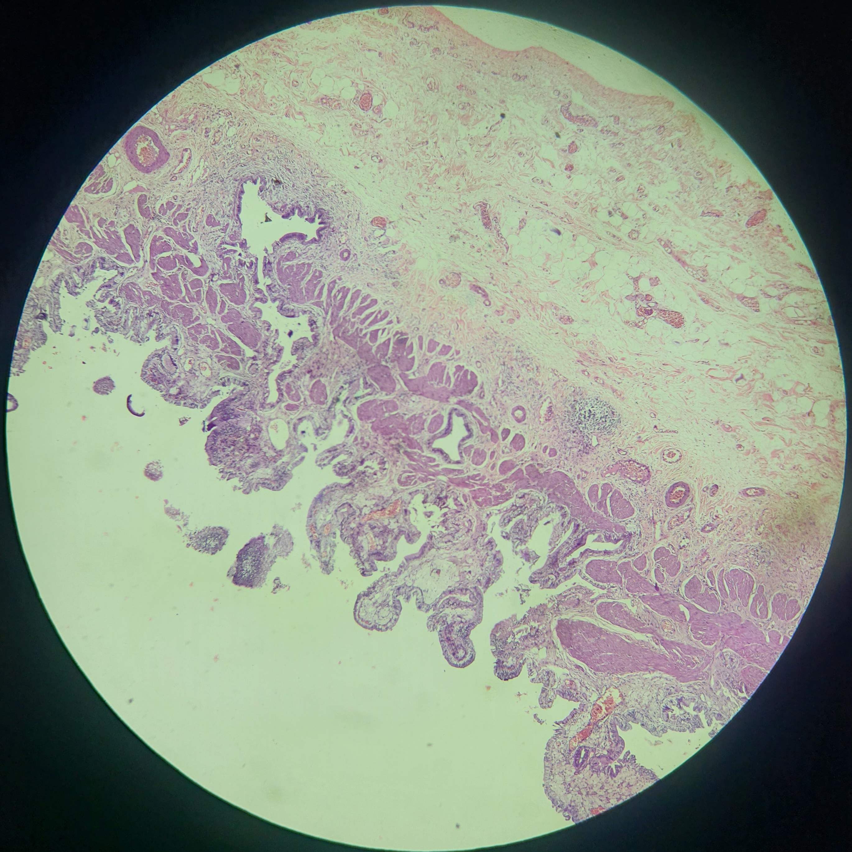 chronic_cholecystitis.jpg