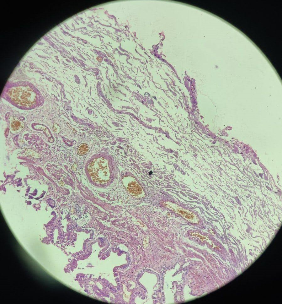chronic cholecystitis.jpg