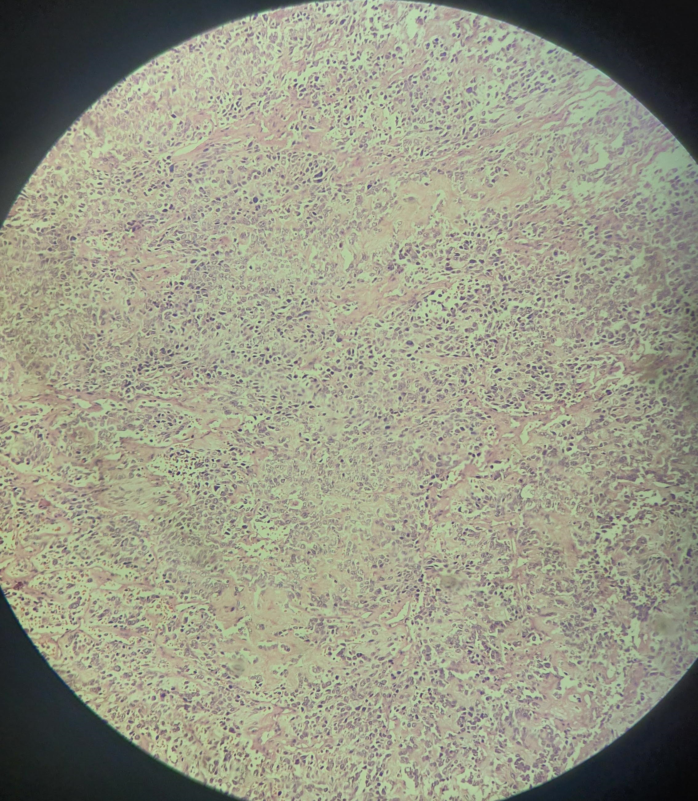 osteosarcoma.jpg