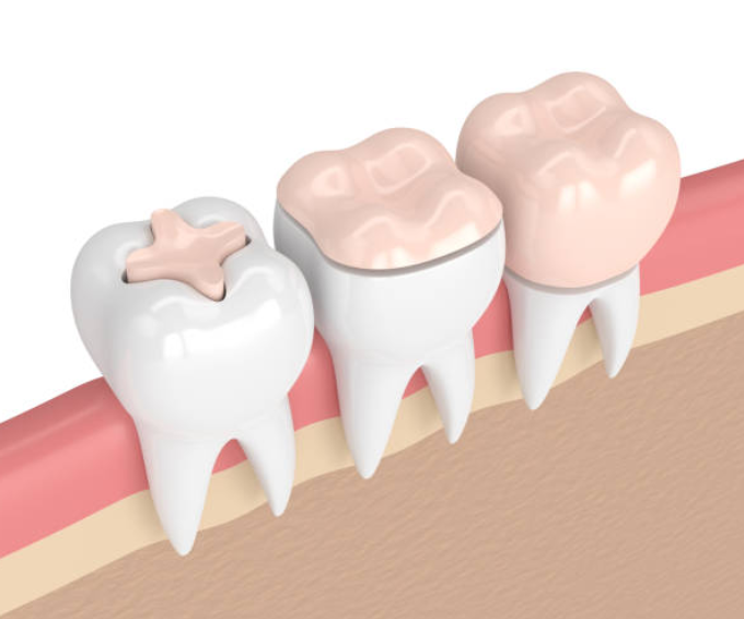 Imagen descriptiva de Restauraciones Dentales