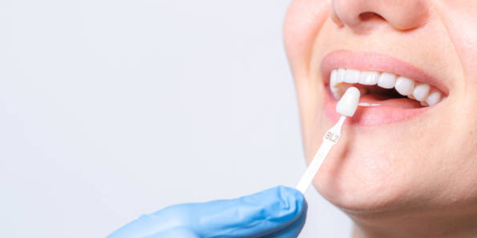 Imagen descriptiva de Estética Dental