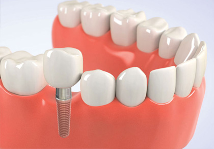 Affordable Dental Implants  
