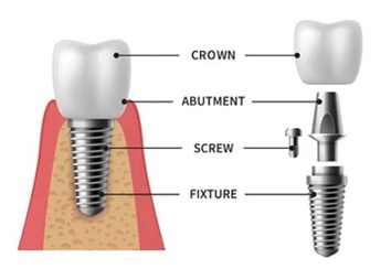 Dental Implant Components