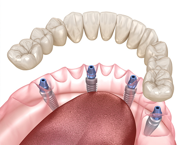 How to Phase Dental Treatment  NOLA Dentures & General Dentistry