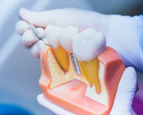 Dental Implant Cutaway