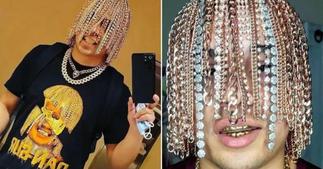 Dan Sur gets gold chains surgically implanted on his head for new look
