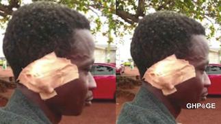 Man bites off friend's ear in a brawl over weed soup