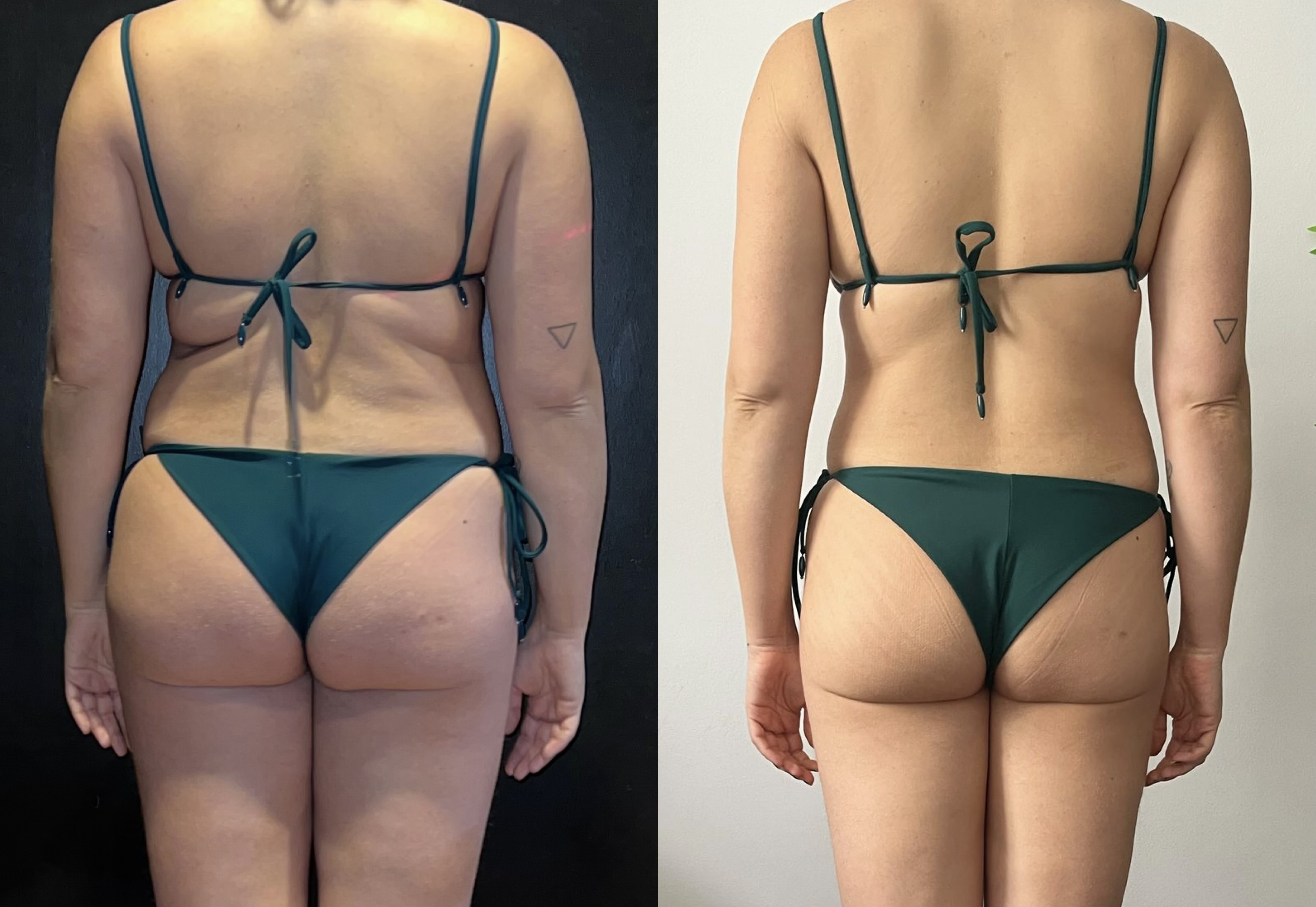 Antes e Depois da Isabela