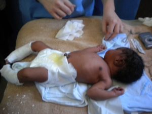 A one-day-old infant born with clubfeet is treated using the Ponseti casting method