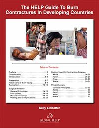 HELP Guide To Burn Contractures In Developing Countries