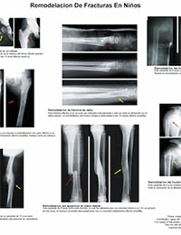 Remodelacion De Fracturas En Ninos