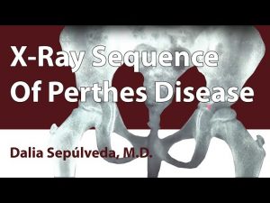 X-Ray Sequence Of Perthes Disease