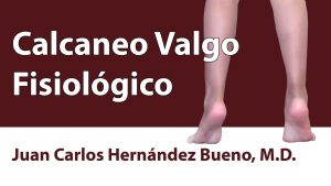 Calcaneo Valgo Fisiológico