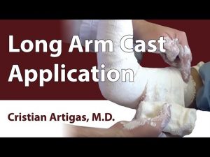 Long Arm Cast Application