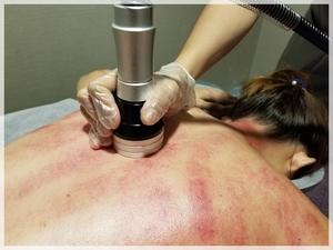 (超級皇牌)活肌靈熱艾罐刮痧痛症治療(去除濕氣,疏通經絡,治療關節痛症,拉傷地方,減輕舊患的痛苦) 診療2小時: