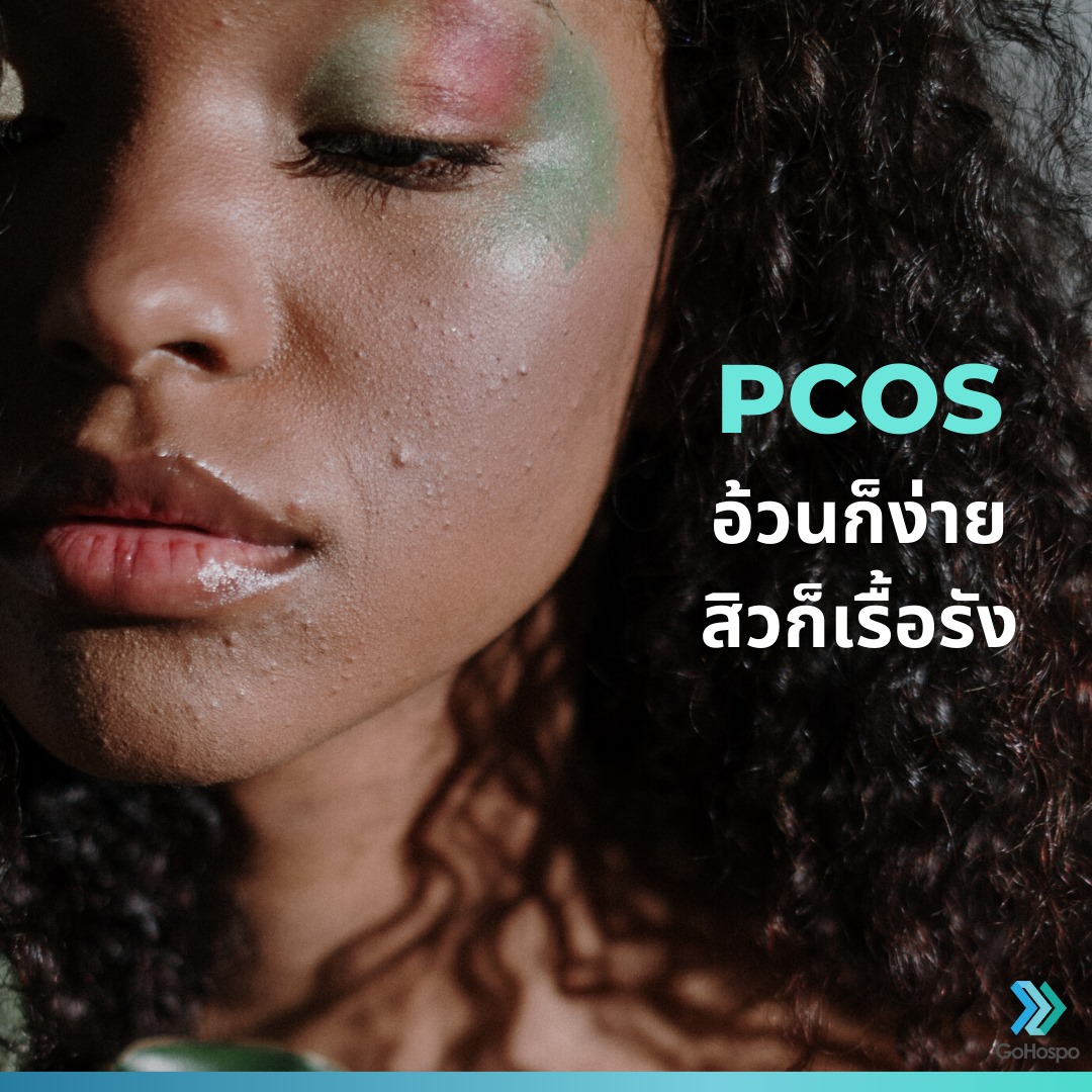 กลุ่มอาการถุงน้ำจำนวนมากในรังไข่ Polycystic Ovary Syndrome; PCOS