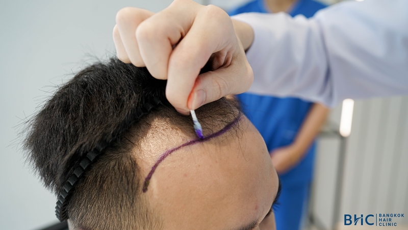 FUE Hair transplant 2500 grafts Health Care Booking Service | Thailand